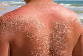 Is Kawakawa Balm Good For Sunburn?